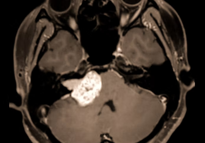 Acoustic neuroma
